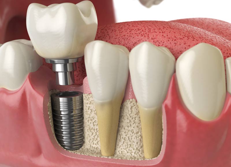 Dental Implants Dentist